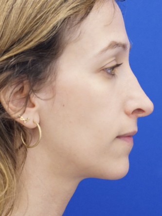 Long Nose Hanging Columella — Before