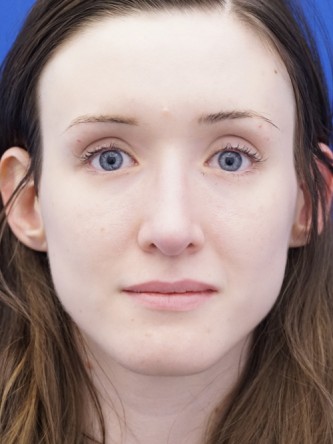 Nasal Profile Irregularity — After