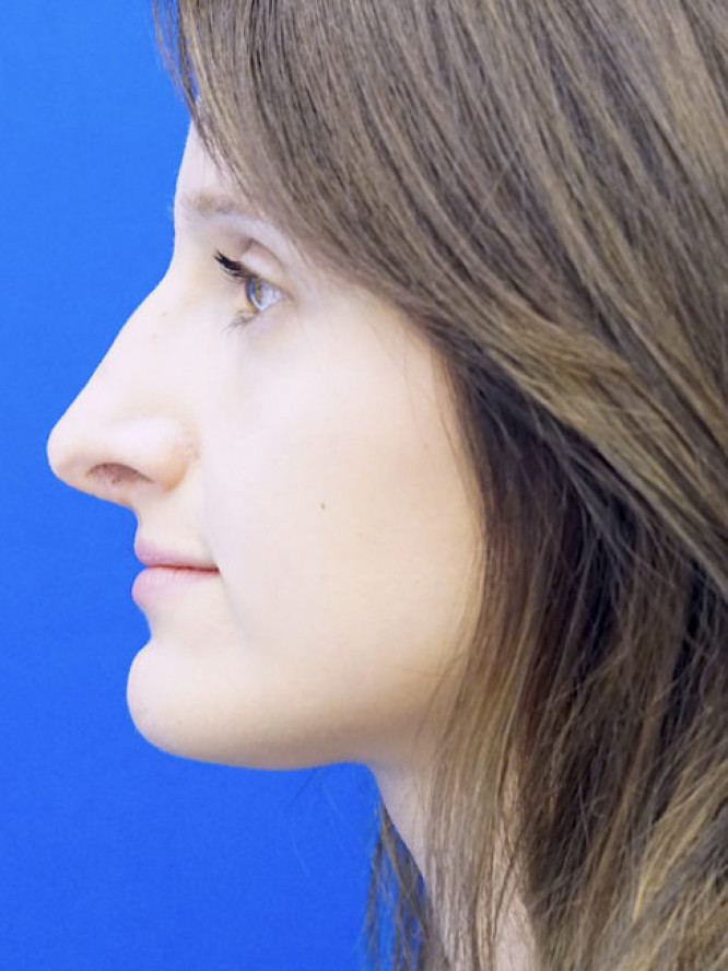 Nasal Profile Bliss — Before