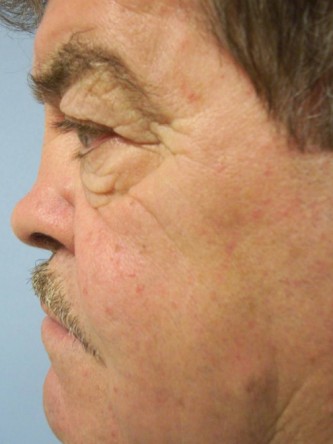 Saddle Nose – Repair Using Ear Cartilage* — Before