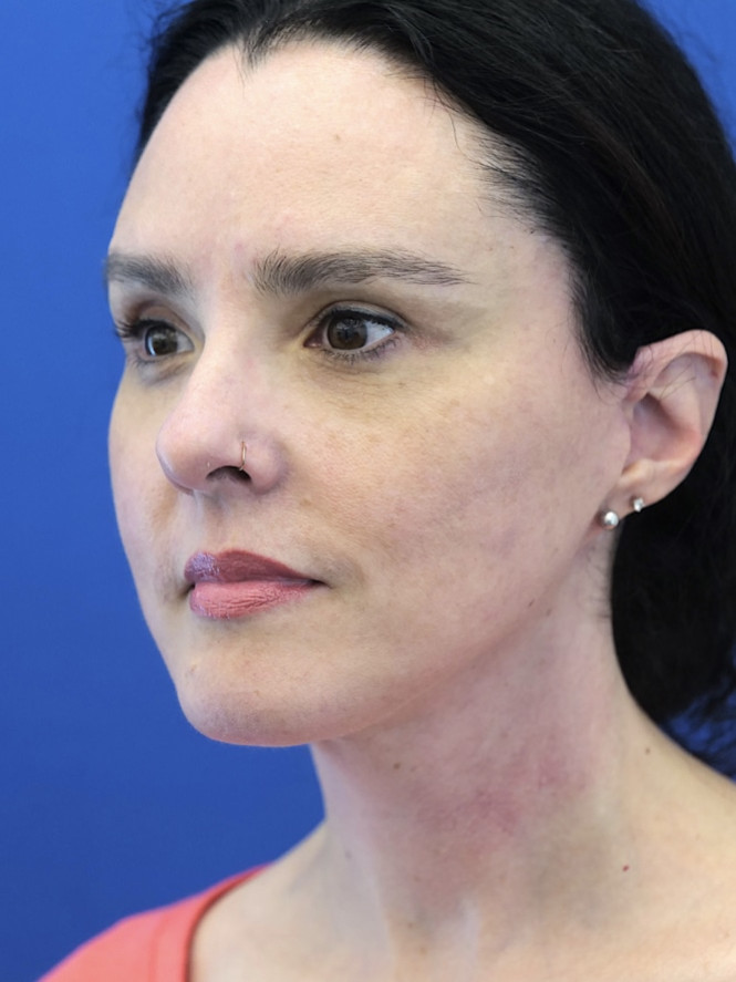 Awesome Jawline — After
