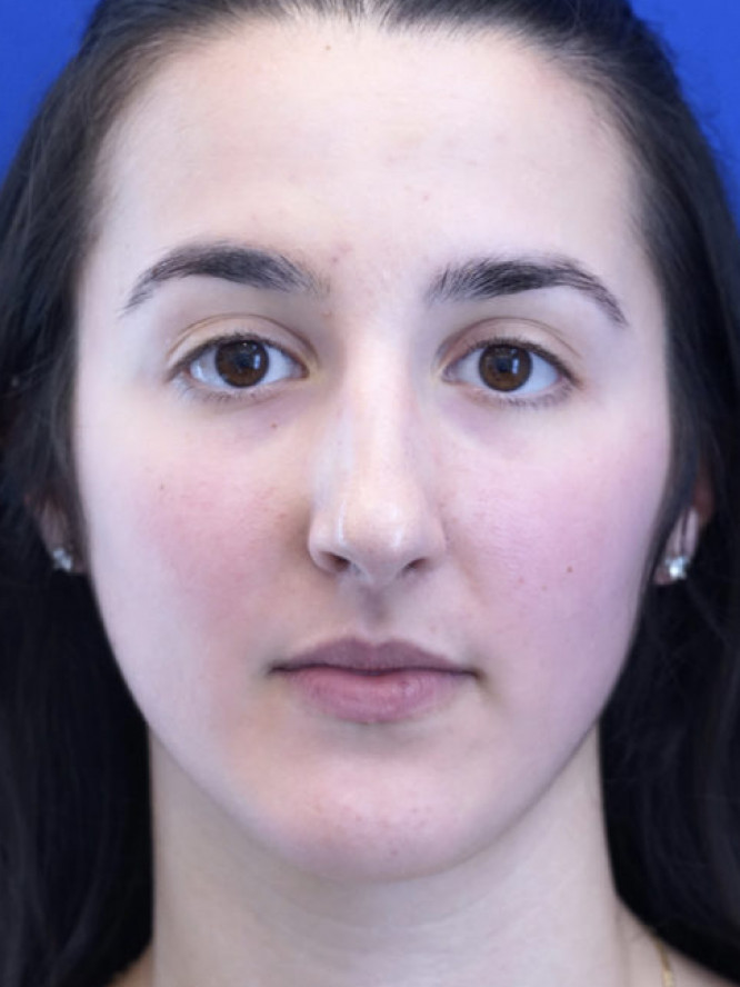 Endonasal Finesse Rhinoplasty — Before