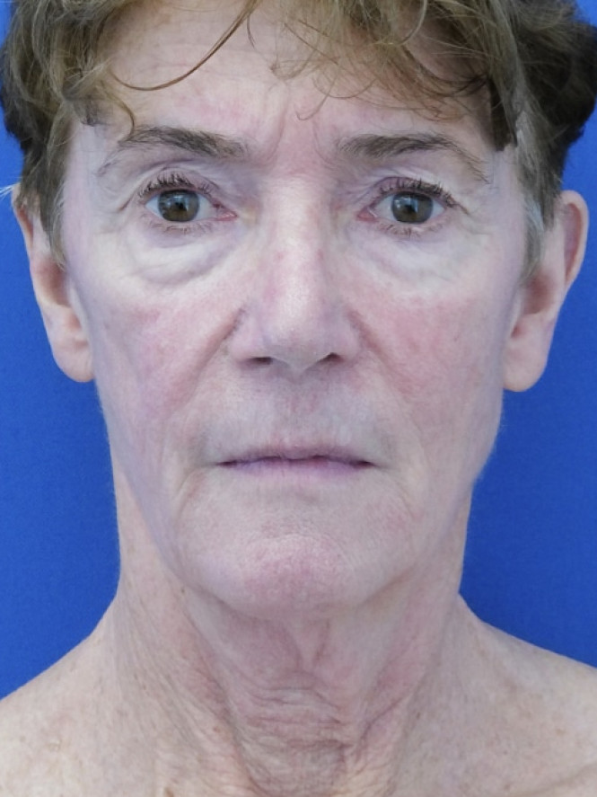 Deep Plane Facelift and Eyelid Lift — Before