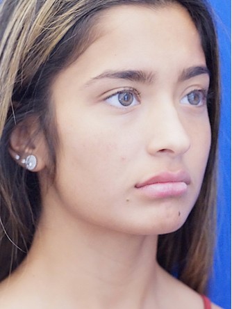 Voluptuous Lip Enhancement* — After