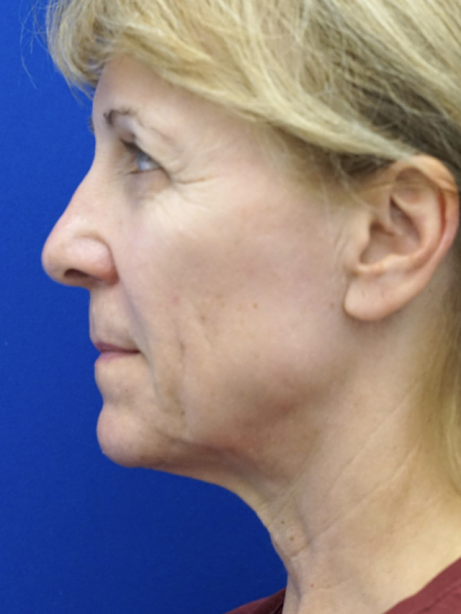 Hairline Browlift — Before