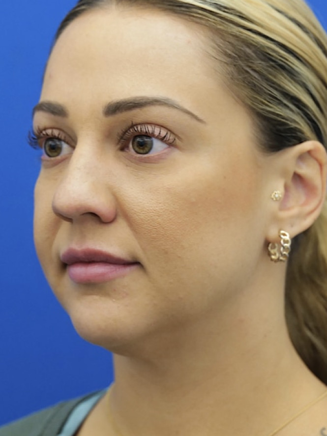 Lower Facial Rejuvenation — Before