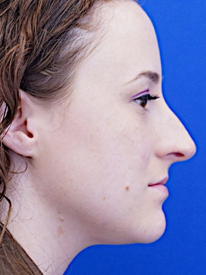 Finesse Nasal Contour — Before
