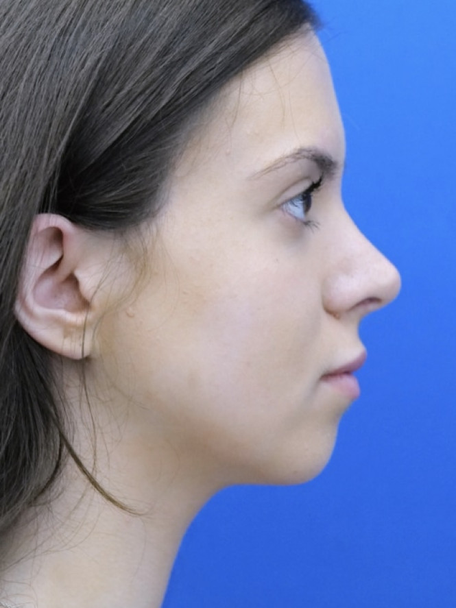 Preservation Rhinoplasty2 — After