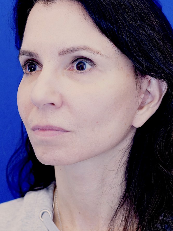 Deep Plane Jowl Lifting — After