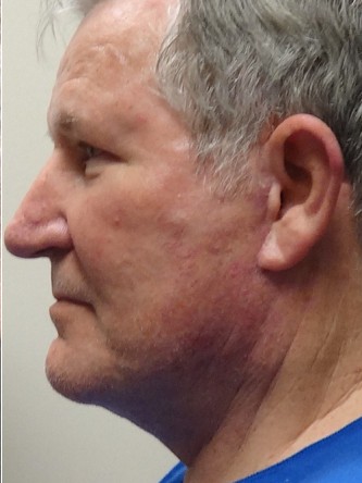 Aging Eyelid Rejuvenation, Facelift, Necklift 1* — After