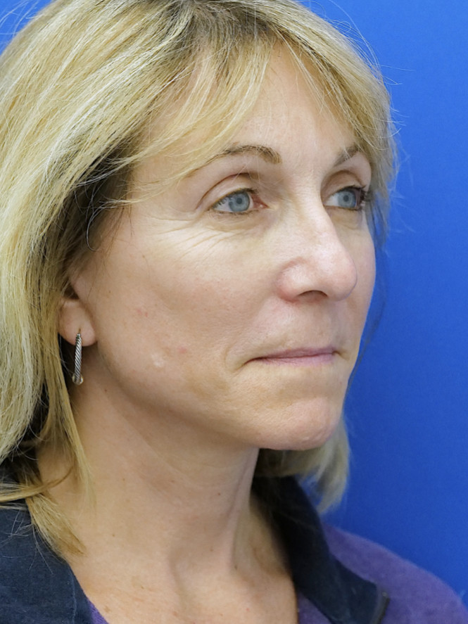 Hairline Browlift — After