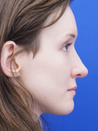 Nasal Profile Irregularity — After