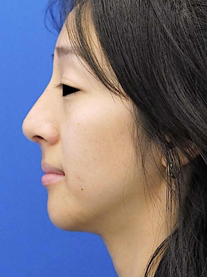 Preservation Ethnic Rhinoplasty — After