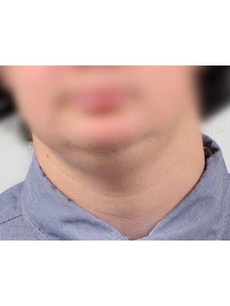 Submental Liposuction* — Before