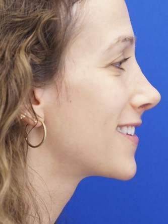 Long Nose Hanging Columella — After