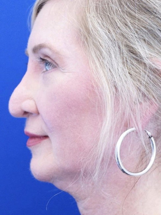 Thick Skin Droopy Nose — Before