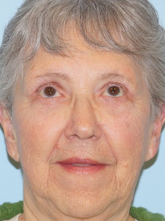 Endoscopic Browlift1* — After