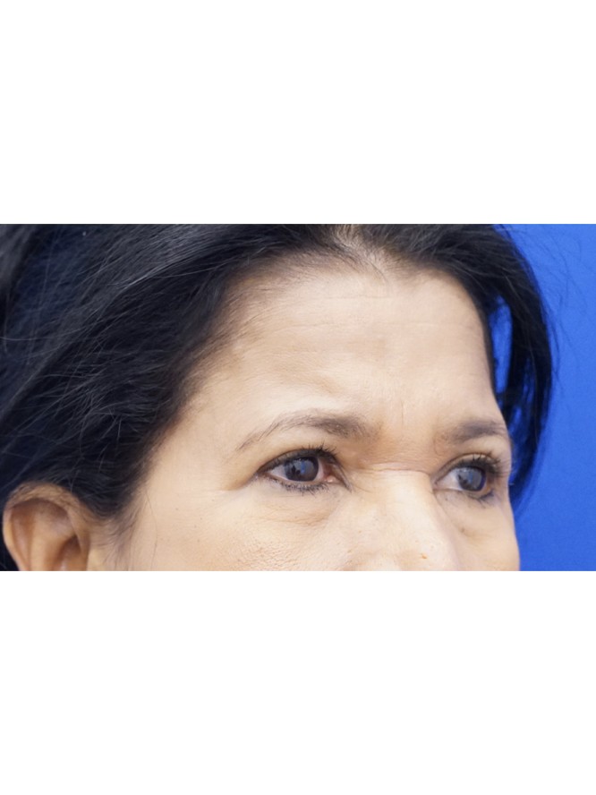 Endoscopic Forehead Lift — Before