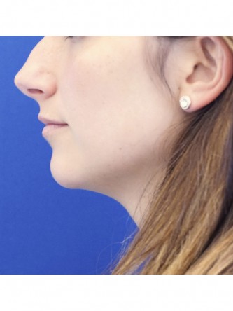 One Year Lip Filler Result — Before