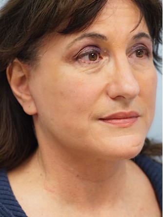 Mini Face and Neck Lift* — After