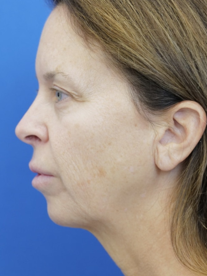 Jowling and Skin Laxity — Before