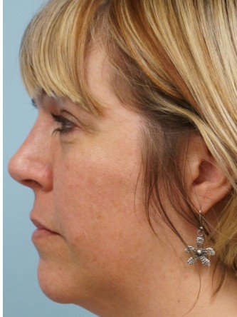 Cheek Augmentation using Voluma* — Before