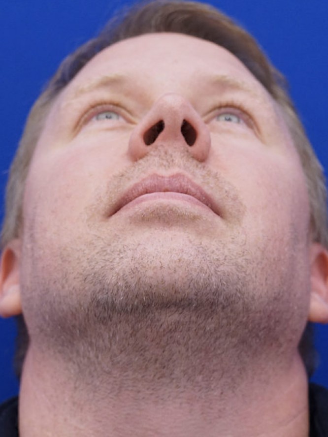 Mild Nasal Deviation — Before