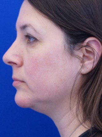 Facelift, Eyelid Lift, and Chin Liposuction* — Before