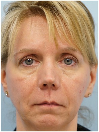 Radiesse to Lower Face* — After