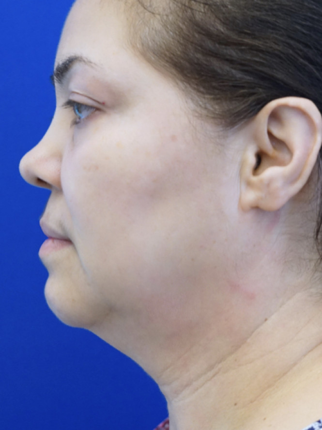 Deep Plane 2 Years Result — Before
