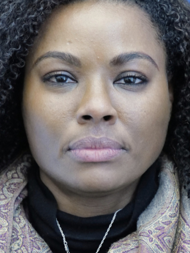 Cheek and Chin — Before