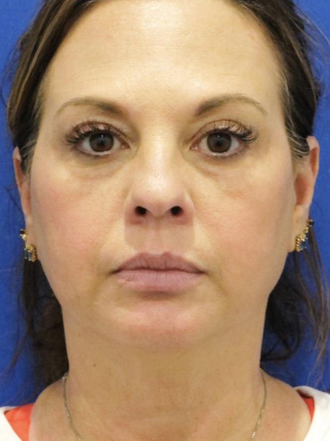 Deep Plane Rejuvenation — Before