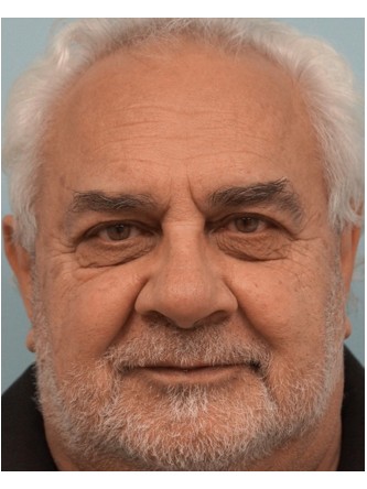 Visual Field Deficit – Eyelid Excess Skin2* — After