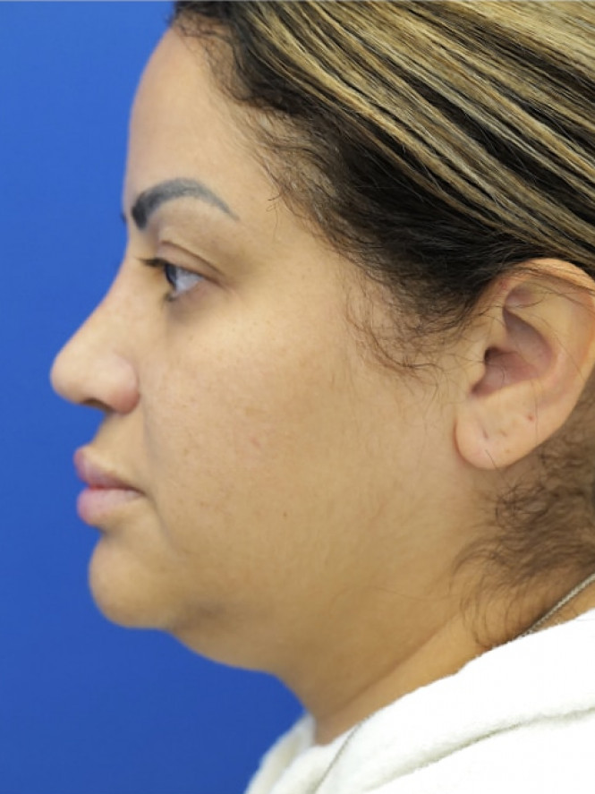 Narrow Nostril Base — After