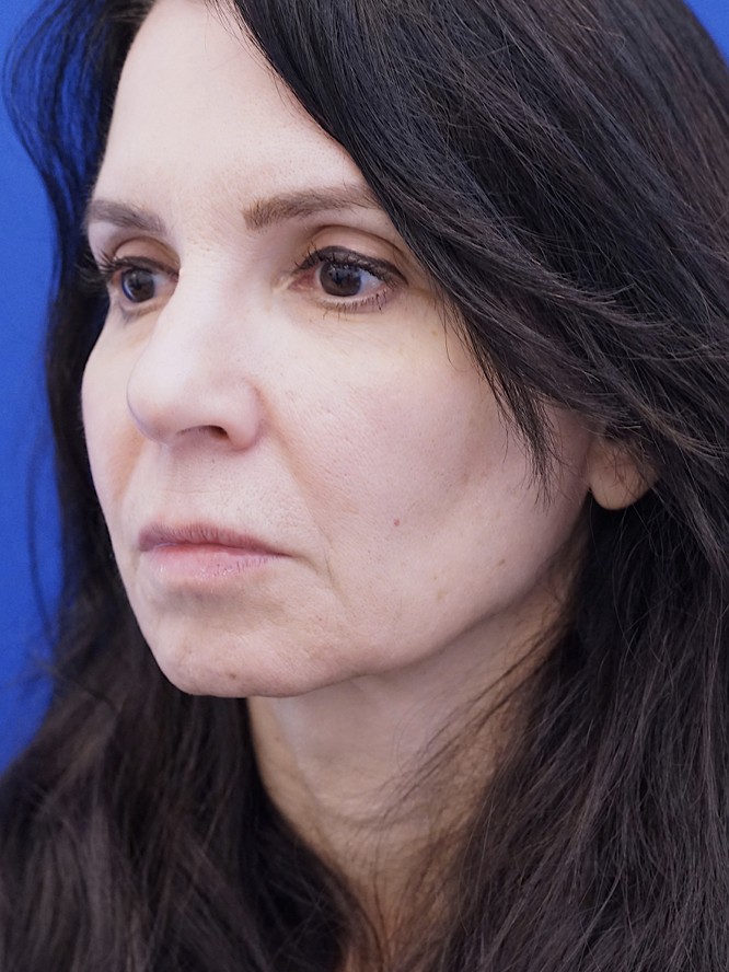 Deep Plane Jowl Lifting — Before