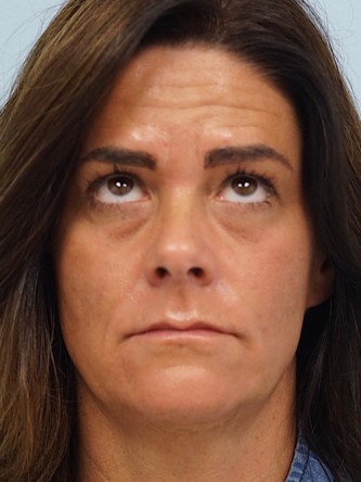 Glabellar Botox and Filler* — Before