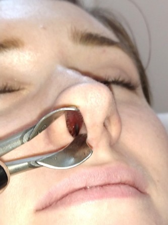 Nasal Profile Irregularity — Before