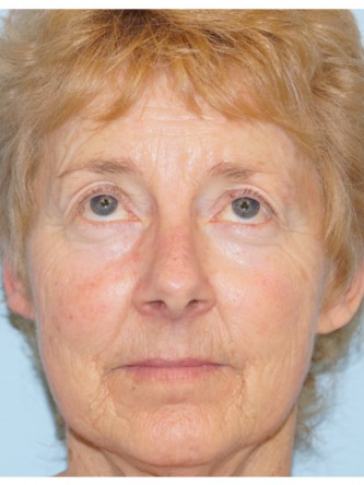 Upper Eyelid Droop2* — Before
