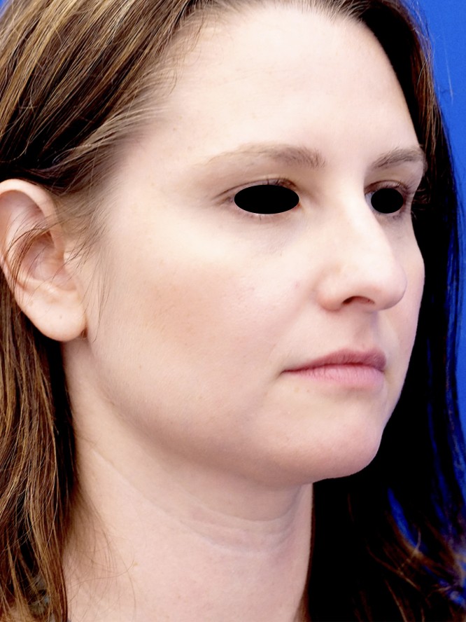 Nasal Aesthetic Nuances — Before