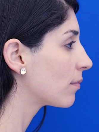 Nasal Bridge Bump* — Before
