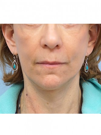 Full Face and Necklift, Upper and Lower Eyelid, Browlift* — After