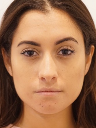 Restylane Silk to Volumize Lower Lip* — Before