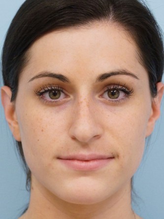 Mild Dorsal Hump & Droopy Tip1* — Before