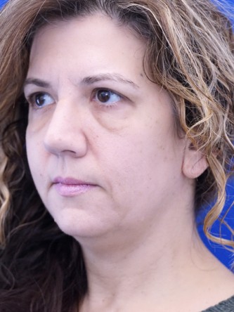 Extended Lower Blepharoplasty* — Before