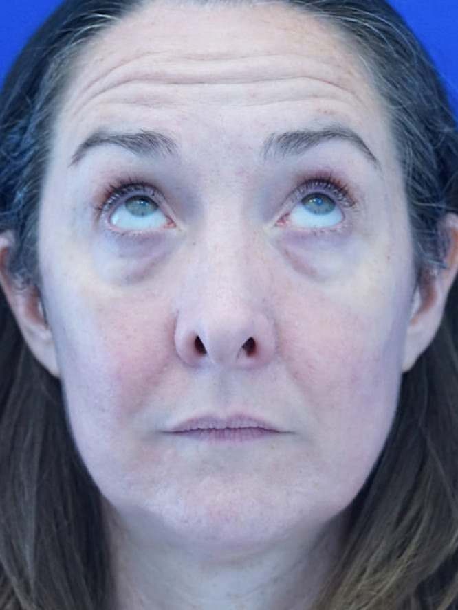 Quad Eyelid Blepharoplasty with Fat Reposition — Before