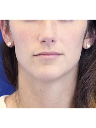 One Year Lip Filler Result — Before