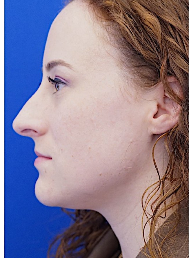 Finesse Nasal Contour — Before