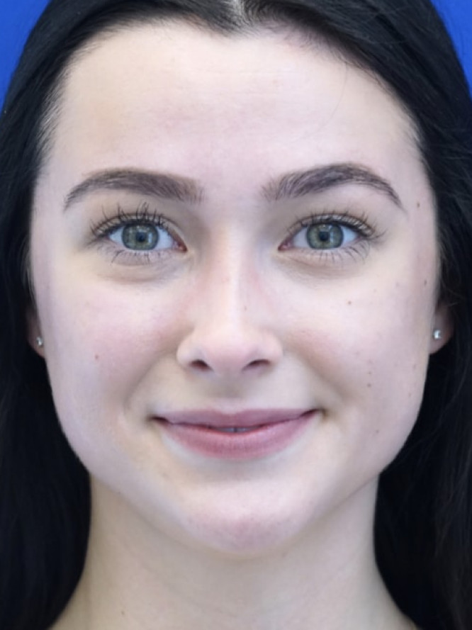 Soften Nasal Bridge — After