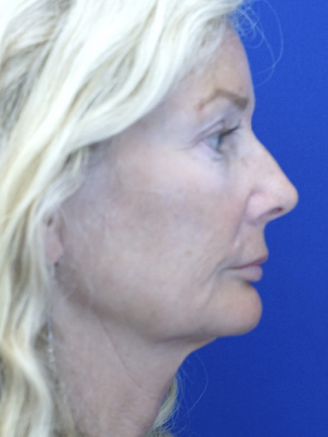 Scintillating Natural Result — Before