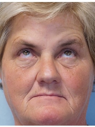 Brow Droop & Upper Eyelid Skin Excess* — After